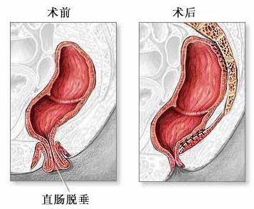 肛肠脱垂