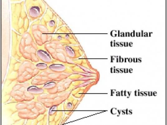 多发性乳腺纤维瘤