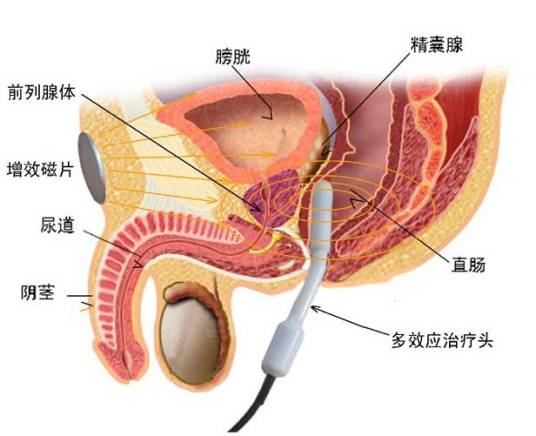 慢性前列腺增生