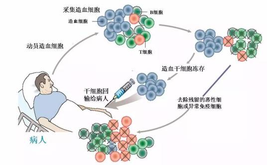 干细胞移植治疗