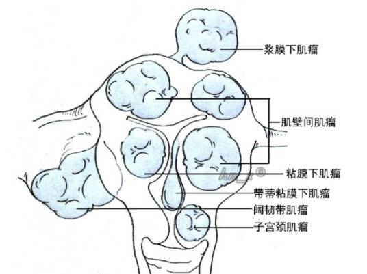 多发子宫肌瘤