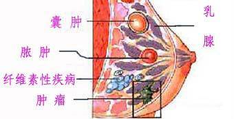 乳房肿瘤