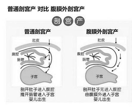 腹膜外剖宫产术（手术）