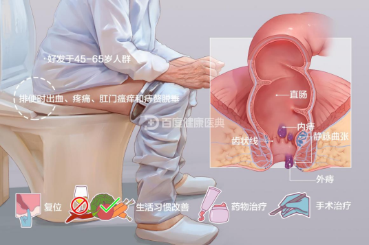 痔疮（病症名称）