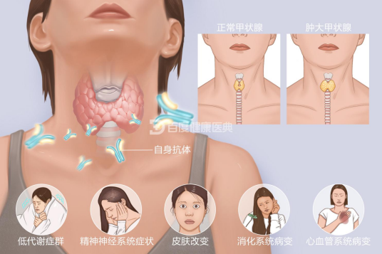 慢性淋巴细胞性甲状腺炎