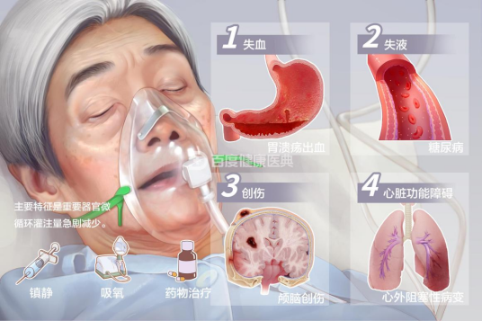 休克（医学术语）