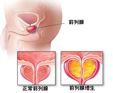 前列腺增生肥大