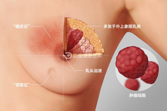 乳腺癌（病症名称）