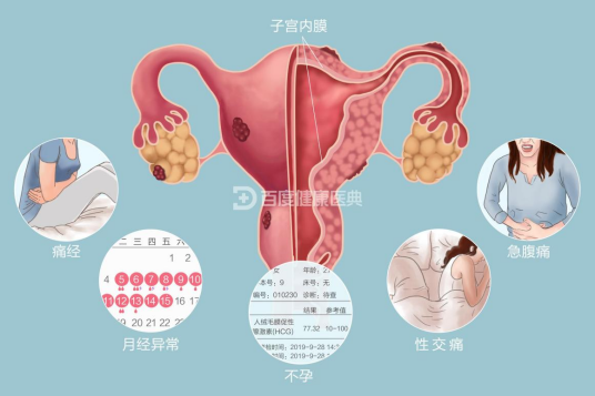 子宫内膜异位症