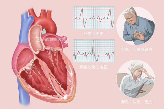 心脏早搏