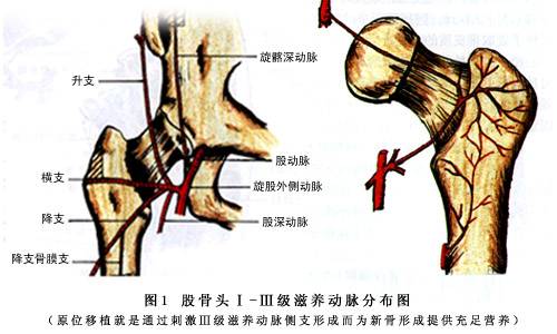 激素性股骨头坏死