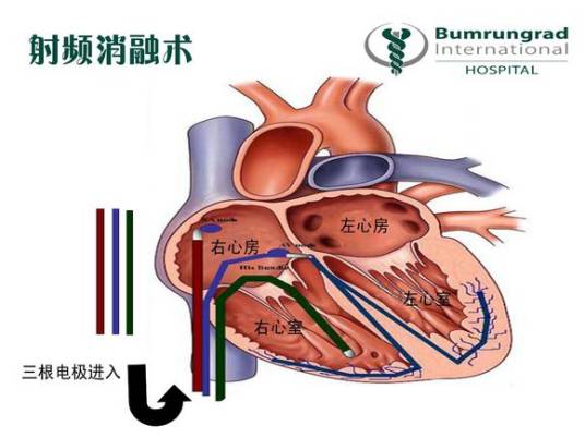 心脏射频消融术