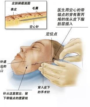 面部悬吊除皱术