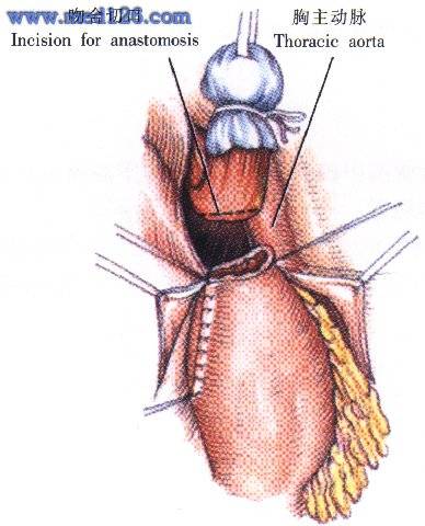 食管下段癌及贲门癌切除术