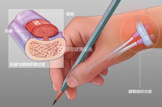 腱鞘炎