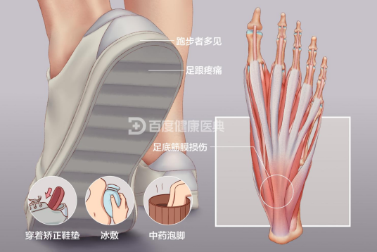 足底筋膜炎