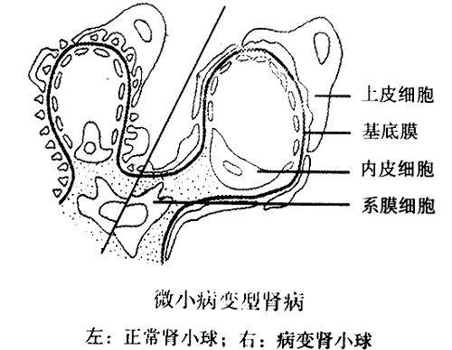 微小残留病变