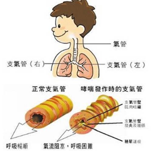 过敏性哮喘