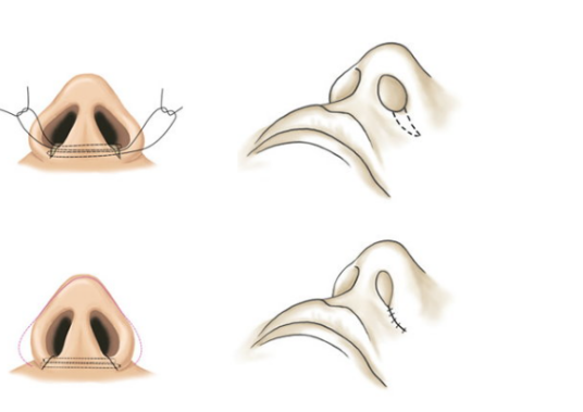 鼻头缩小手术