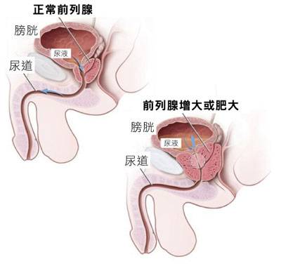 老年前列腺增生症