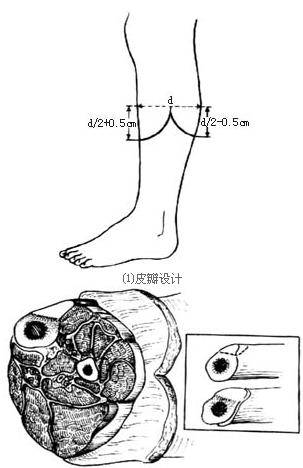 小腿截体术